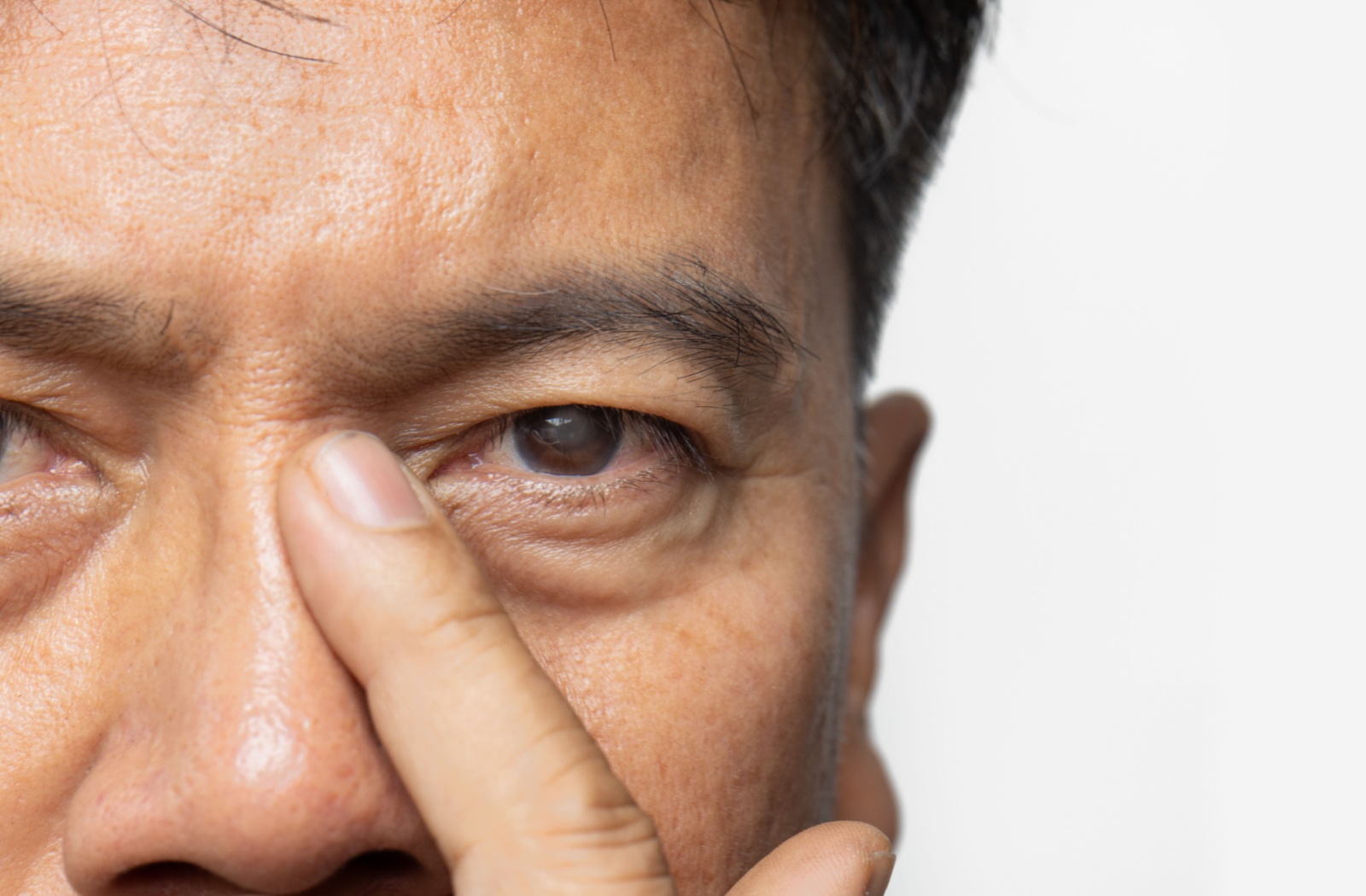 An older adult rests a finger on the bridge of his nose. His eyes have cataracts.