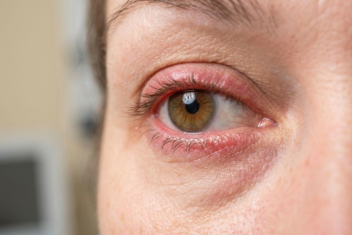 Close-up of an adult's open eye with a hazel iris, visibly red and inflamed eyelids, and redness in the white of the eye.